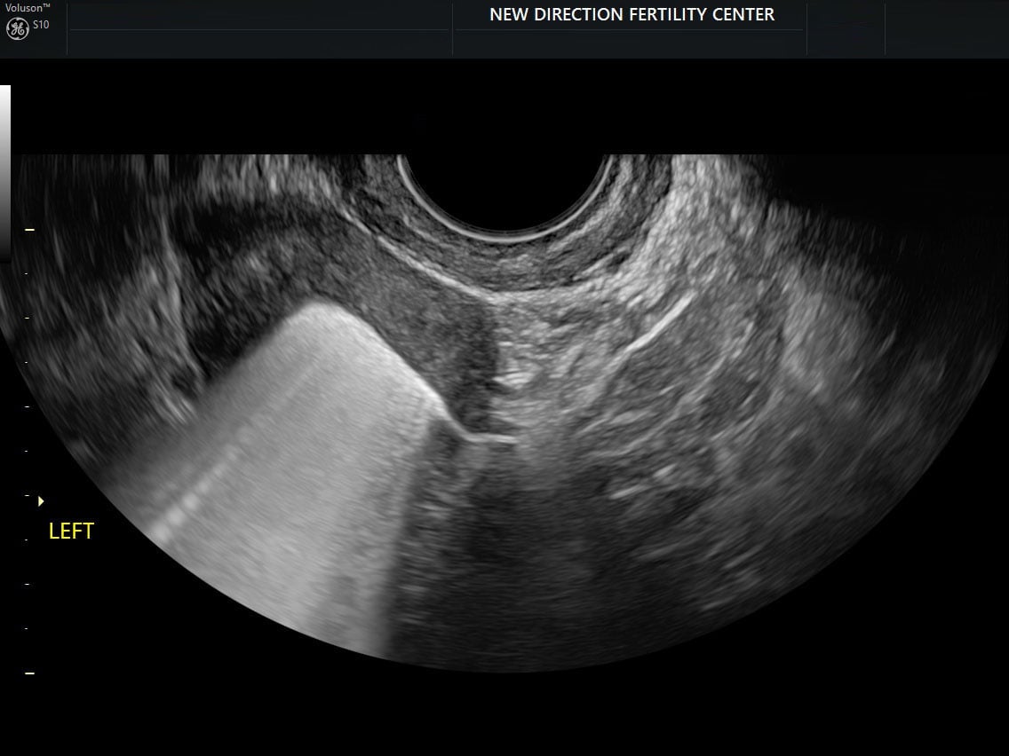 Left fallopian tube (2)