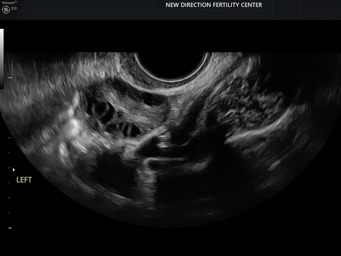 Left ovary with spillage