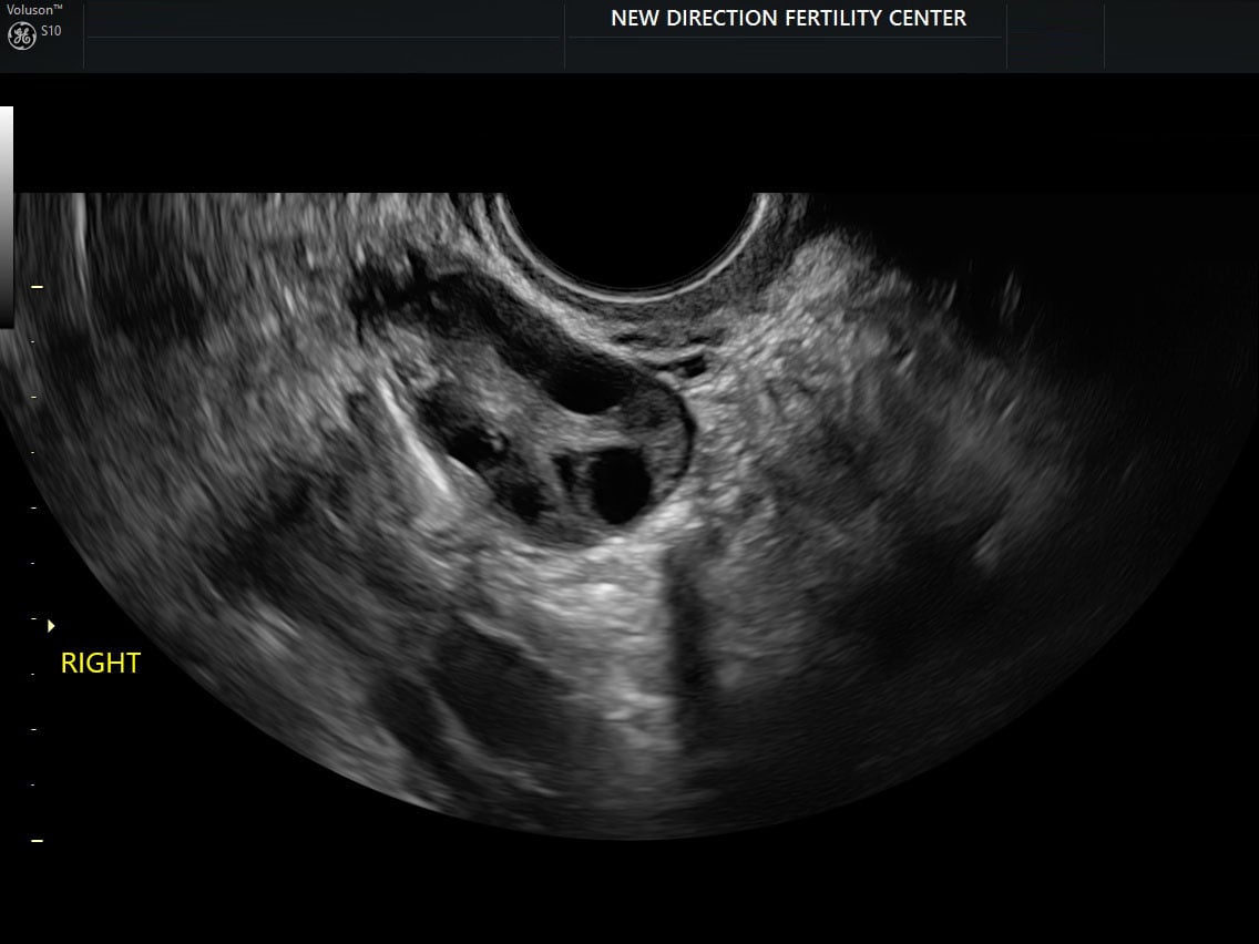 Portion right fallopian tube with spillage around ovary
