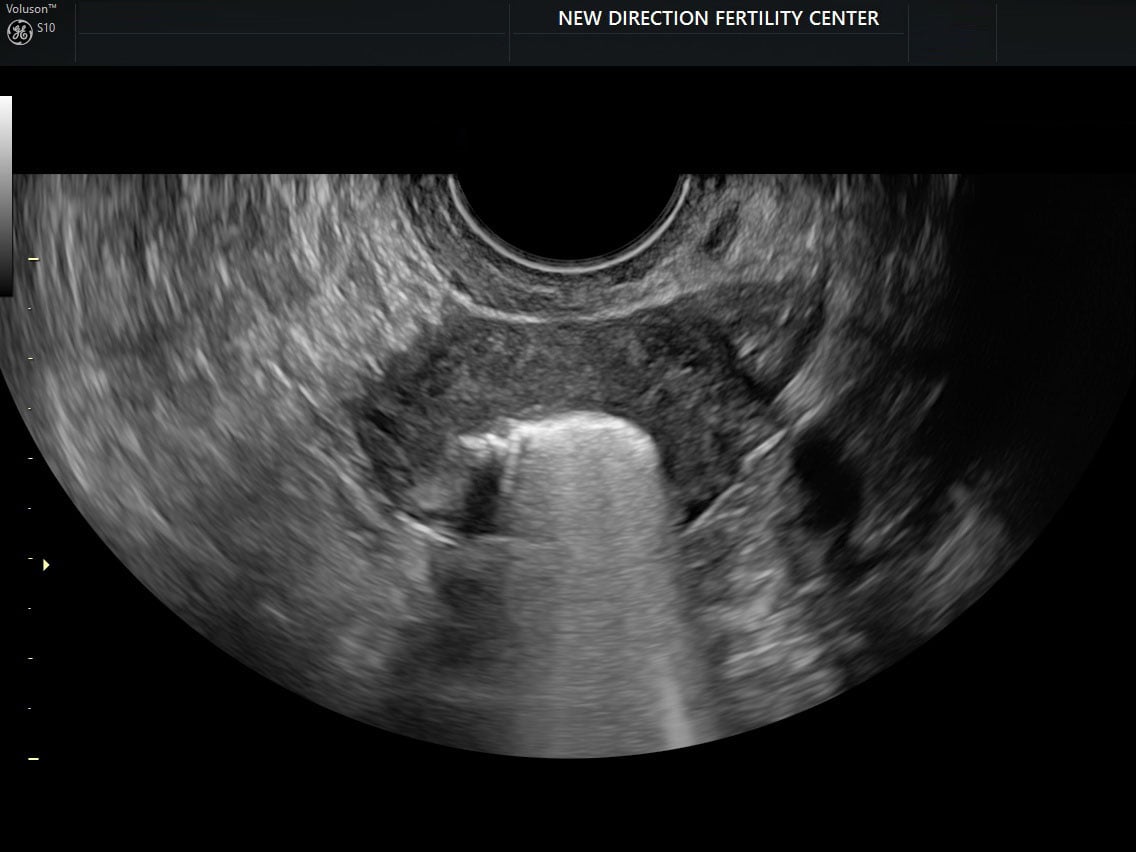 Transverse endometrium with foam